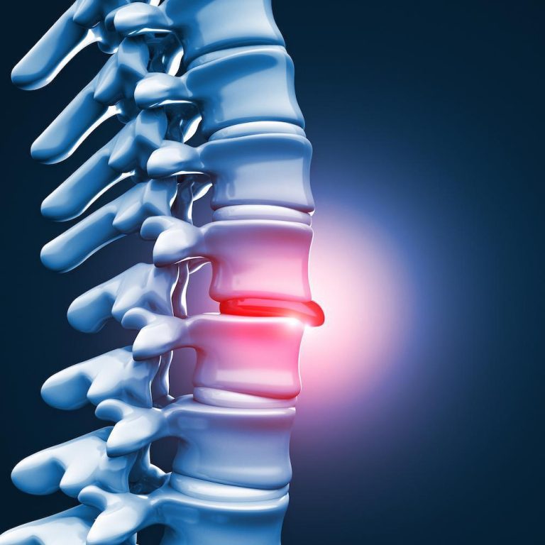 Understanding your treatment options for a herniated disc